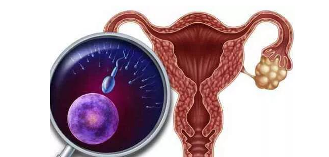 子宫肌瘤：深入了解其成因，守护女性健康